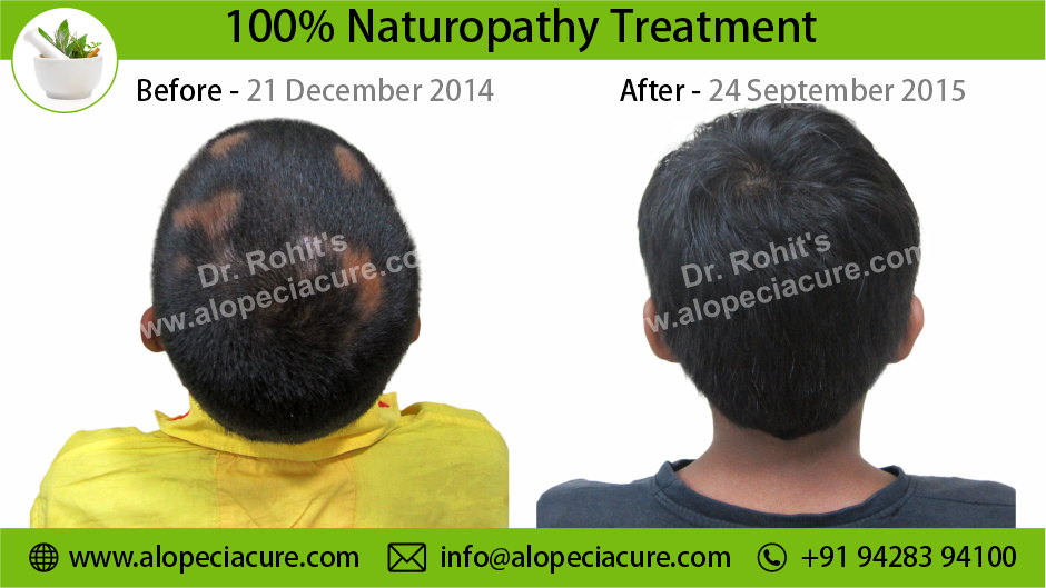 Alopecia Areata Result 6